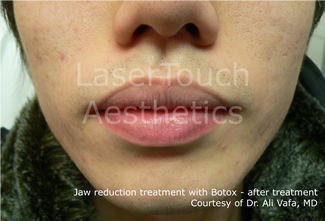 Jaw reduction treatment with Botox results - after treatment long island oyster bay